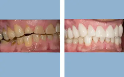 Before and After